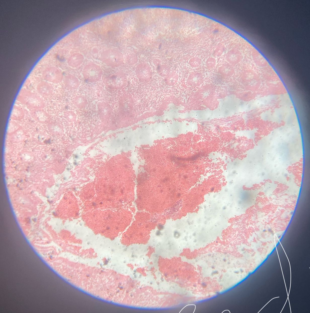 Acute Appendicitis