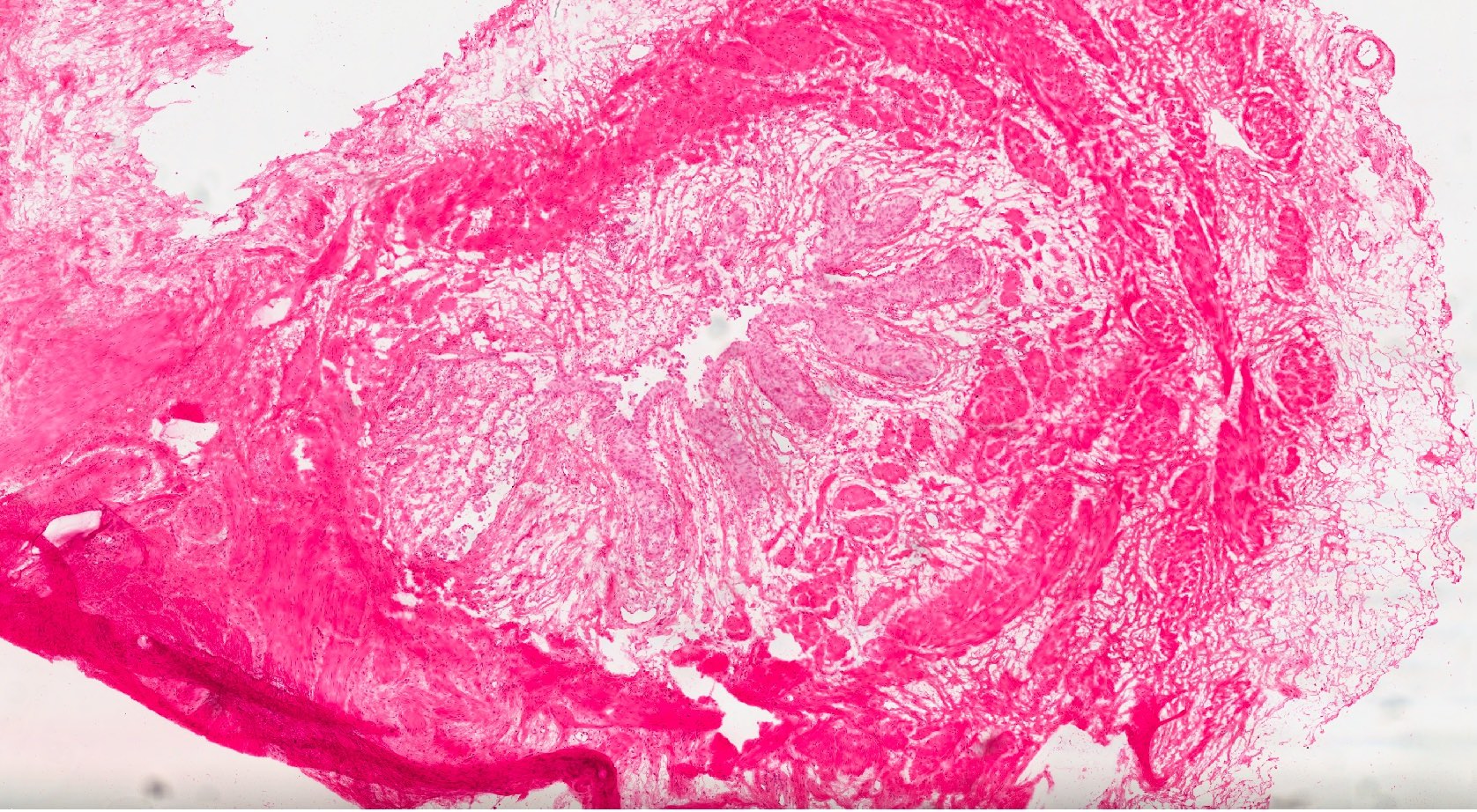 Carcinoma In Situ