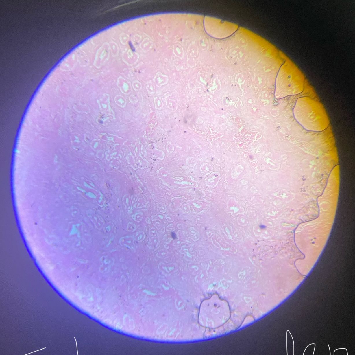 Fibroadenoma