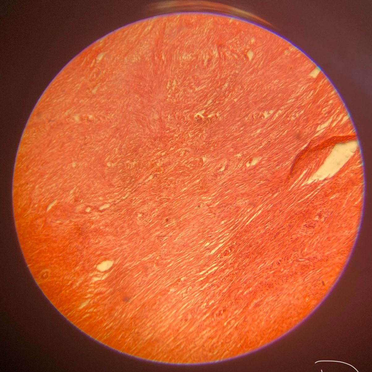 Leiomyoma