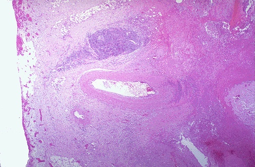 Peptic Ulcer