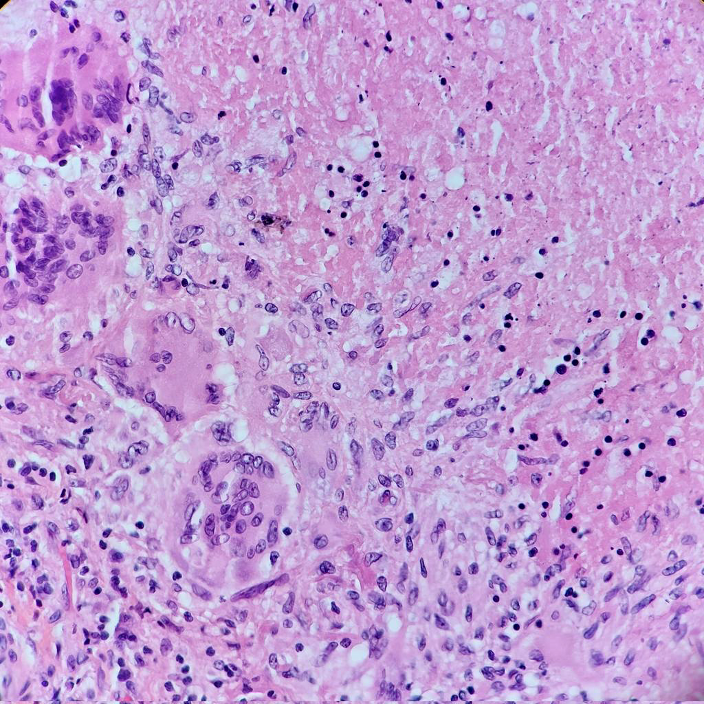 TB Granuloma slide 2