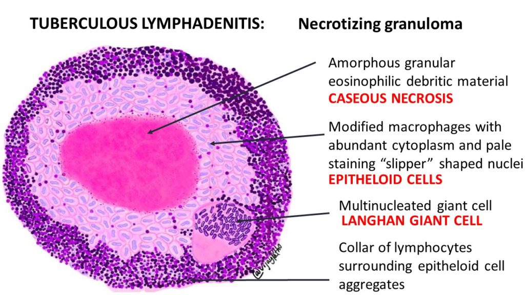 TB Granuloma slide 1